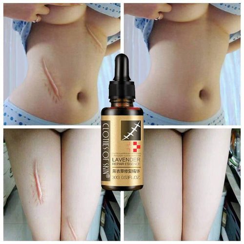 Essential Massage oils Scar Removal