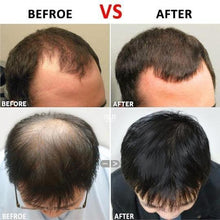 Load image into Gallery viewer, Hair Regrowth Derma Roller