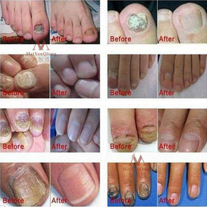 Nail Treatment Cream
