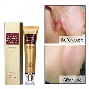 Original Acne Scar Remover Cream